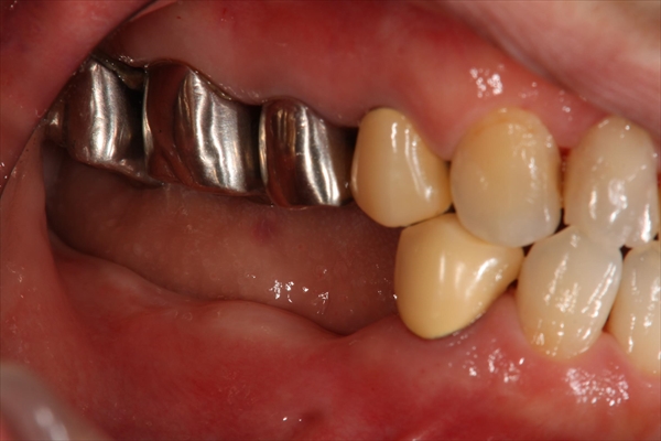 奥歯が抜けている場合のインプラント治療・術前