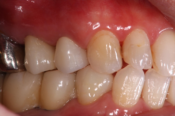 奥歯が抜けている場合のインプラント治療・術後