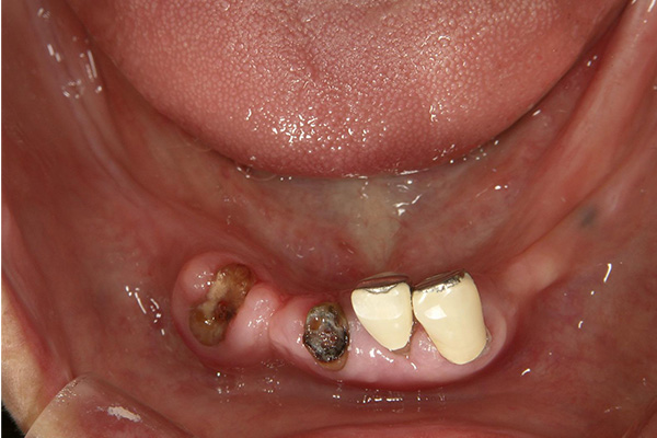 入れ歯をしている場合のインプラント治療　術前