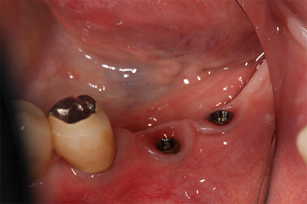 奥歯が抜けている場合のインプラント治療　アバットメントはずしたところ１
