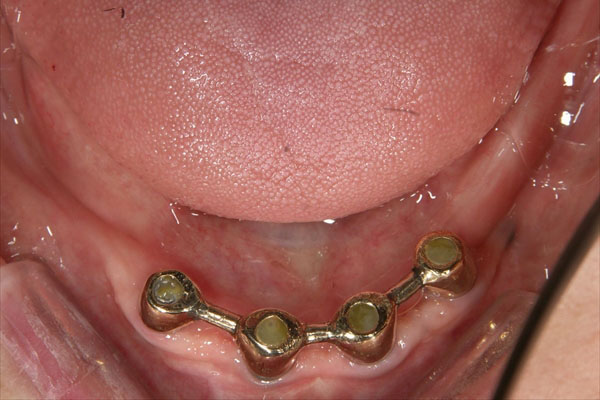 入れ歯を入れている場合のインプラント治療・術中