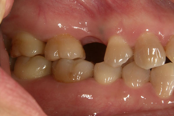 歯が１本抜けている場合のインプラント治療・術前