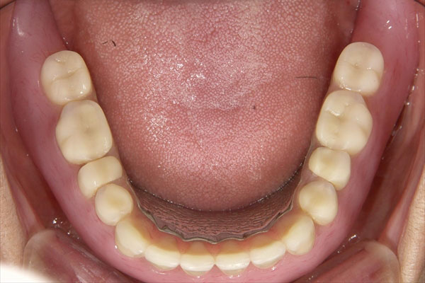 入れ歯を入れている場合のインプラント治療・術後